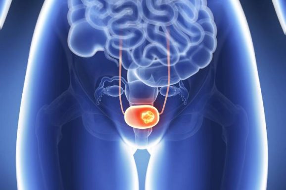 O câncer de bexiga é uma das neoplasias mais comuns do trato urinário e o nono tipo mais incidente, em nível mundial, com aproximadamente 550.000 novos casos ao ano. (SEBASTIAN KAULITZKI/Getty Images)